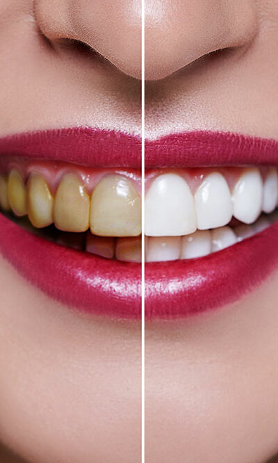 Dental veneers&#8217; cost, procedure, and results