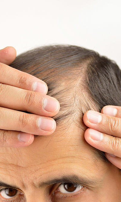 Ways to manage hair loss