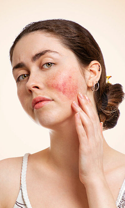 Type of rosacea and how the skin condition can be treated