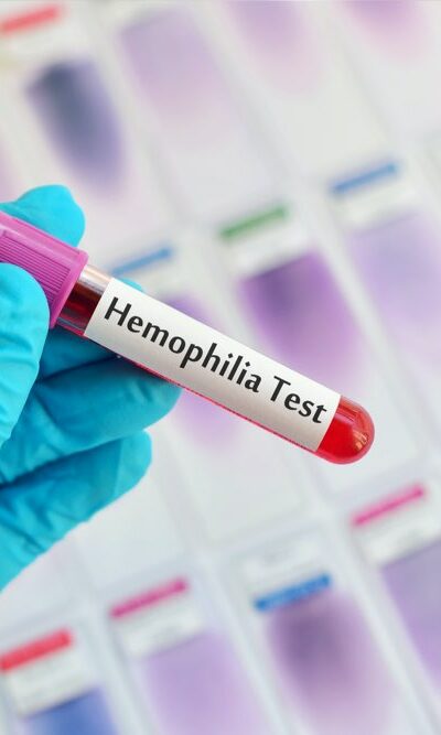 4 best foods for hemophilia