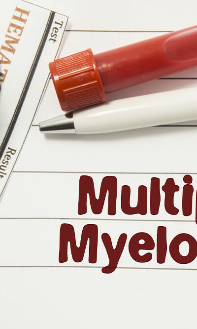 6 early signs of multiple myeloma