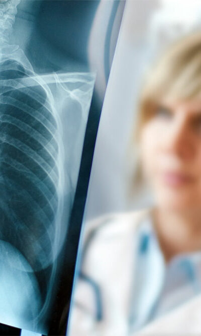 5 warning signs of lung cancer that should not be ignored