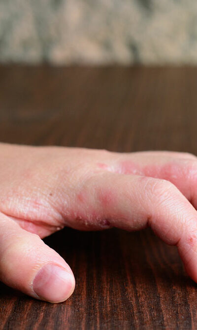 8 first-line treatment options for atopic dermatitis in infants