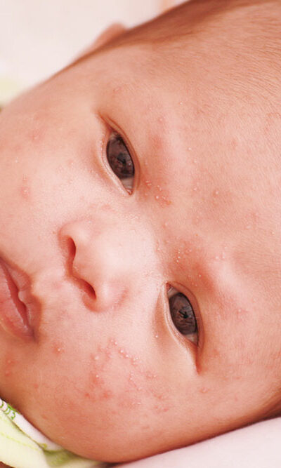 Symptoms, causes, and remedies for atopic dermatitis in children